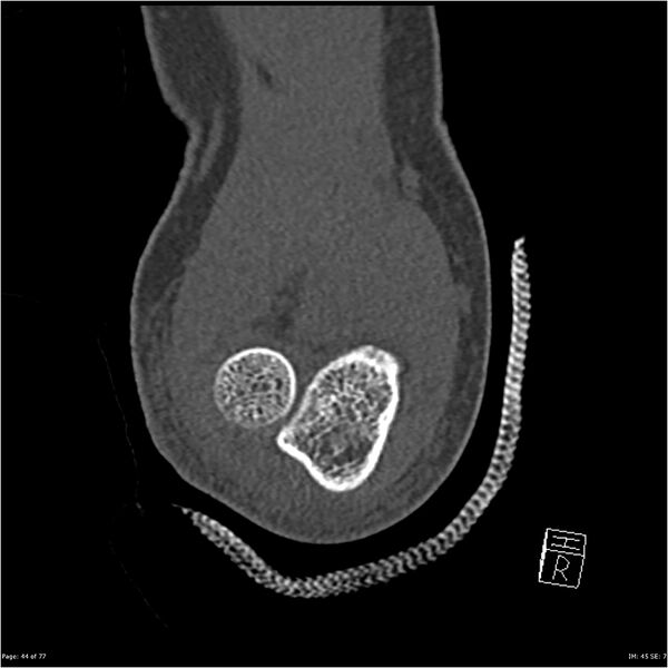 File:Capitellum fracture (Radiopaedia 23352-23426 Coronal bone window 44).jpg