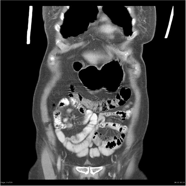 File:Carcinoid tumor of the ileum with metastasis to orbit (Radiopaedia 28165-28425 B 3).jpg