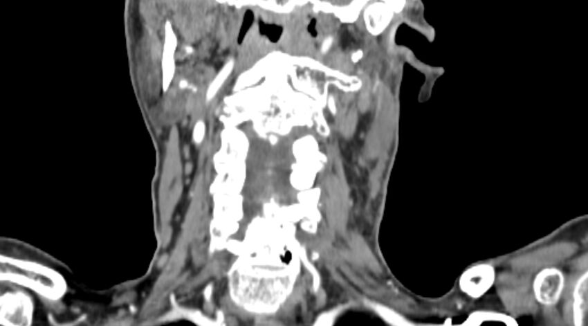 Carotid artery pseudoaneurysm (Radiopaedia 84030-99259 D 61).jpg