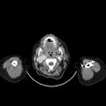 Carotid body tumor (Radiopaedia 21021-20948 A 14).jpg