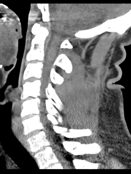 File:Cavernoma of cervical cord (Radiopaedia 50838-56346 B 42).png