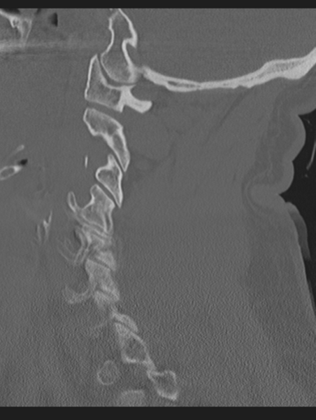 File:Cavernoma of cervical cord (Radiopaedia 50838-56346 Sagittal bone window 28).png