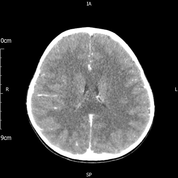 File:Cavernous sinus thrombosis (Radiopaedia 79414-92510 Axial Brain 121).jpg
