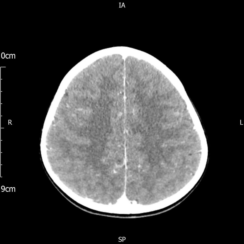 Cavernous sinus thrombosis (Radiopaedia 79414-92510 Axial Brain 139).jpg