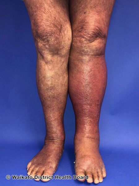 File:Cellulitis of the left leg (DermNet NZ cellulitis-012).jpg