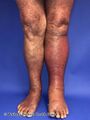 Cellulitis of the left leg (DermNet NZ cellulitis-012).jpg