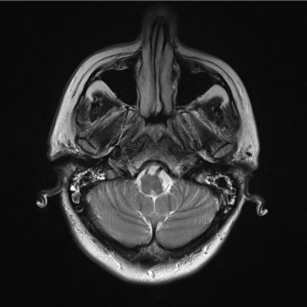 File:Central base of skull meningioma (Radiopaedia 53531-59549 Axial T2 4).jpg