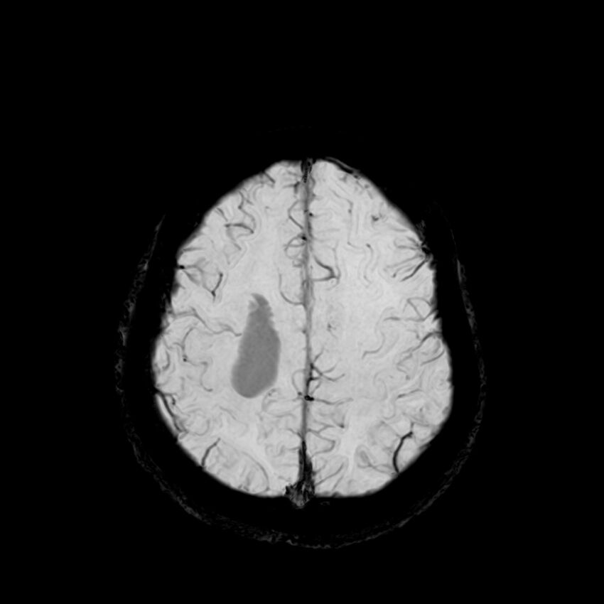 Central neurocytoma (Radiopaedia 79320-92380 Axial SWI 111).jpg