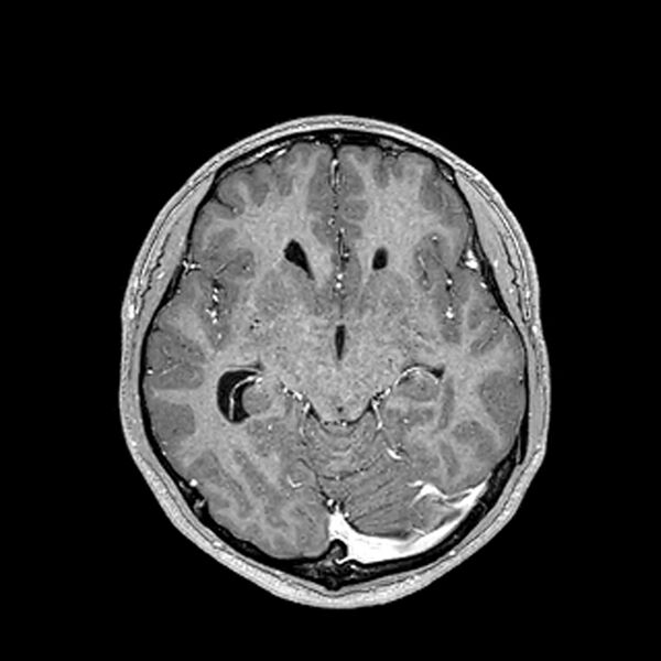 File:Central neurocytoma (Radiopaedia 79320-92380 Axial T1 C+ 110).jpg