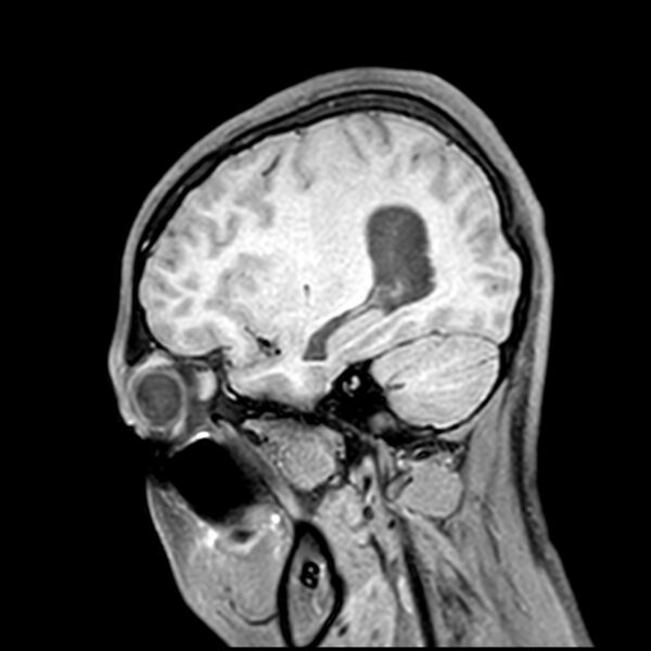 File:Central neurocytoma (Radiopaedia 79320-92380 Sagittal T1 188).jpg