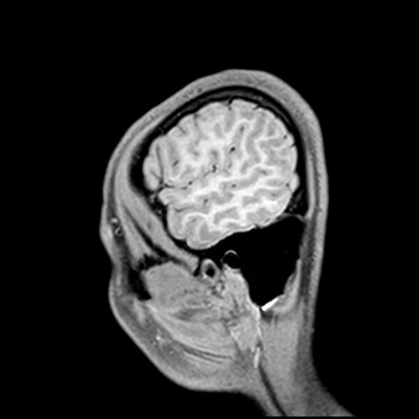 File:Central neurocytoma (Radiopaedia 79320-92380 Sagittal T1 224).jpg