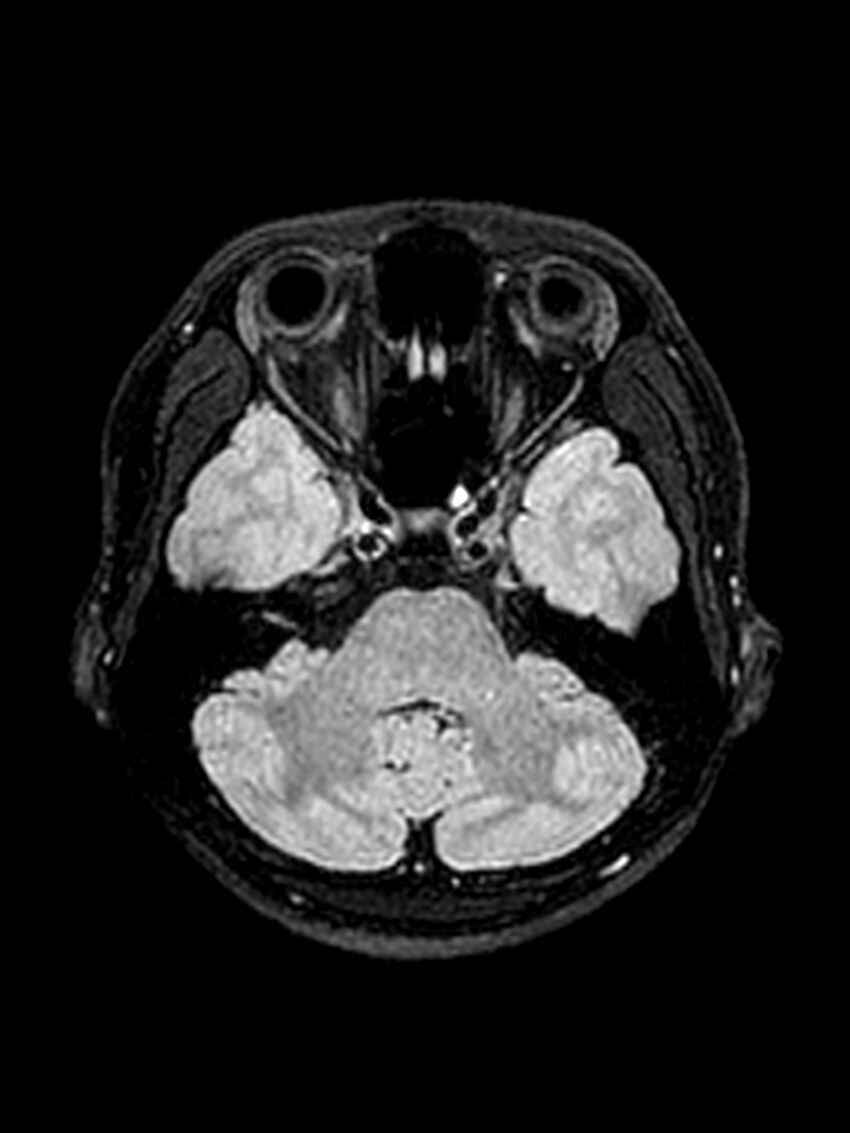 Central neurocytoma (Radiopaedia 79320-92381 Axial FLAIR 121).jpg