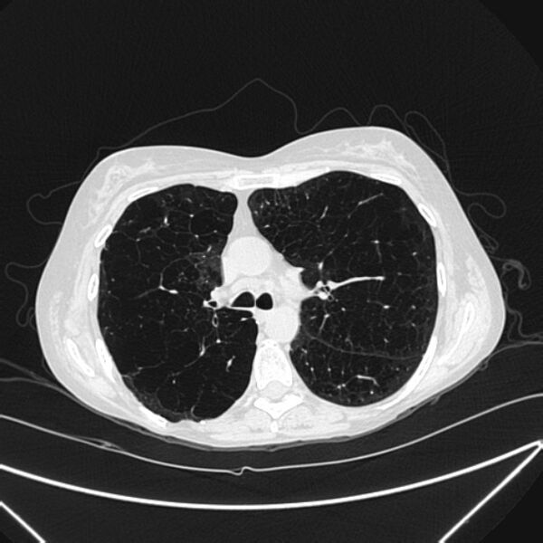 File:Centrilobular pulmonary emphysema (Radiopaedia 24495-24789 Axial lung window 37).jpg