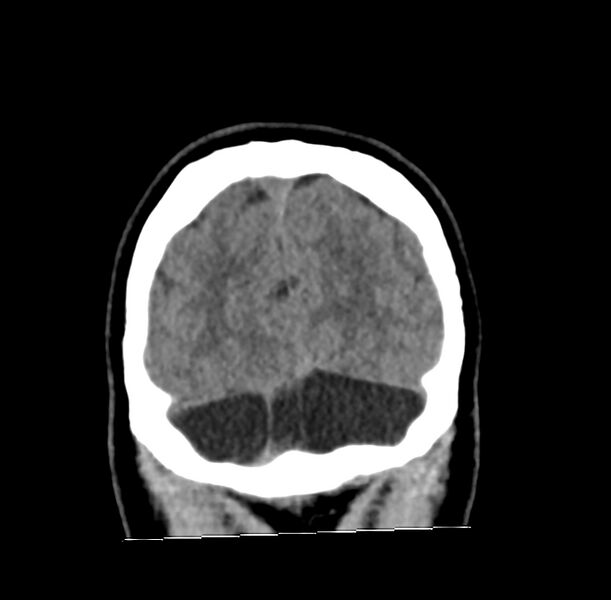 File:Cerebellar agenesis (Radiopaedia 30203-30817 Coronal non-contrast 44).jpg