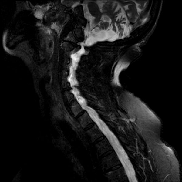 File:Cerebellar ataxia with neuropathy and vestibular areflexia syndrome (CANVAS) (Radiopaedia 74283-85159 Sagittal T2 fat sat 3).jpg