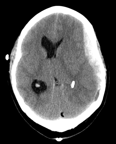 File:Cerebellar ependymoma complicated by post-operative subdural hematoma (Radiopaedia 83322-97737 Axial non-contrast 16).png