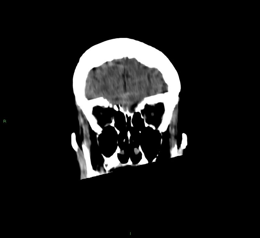 Cerebellar hemorrhage (Radiopaedia 58792-66026 Coronal non-contrast 51).jpg