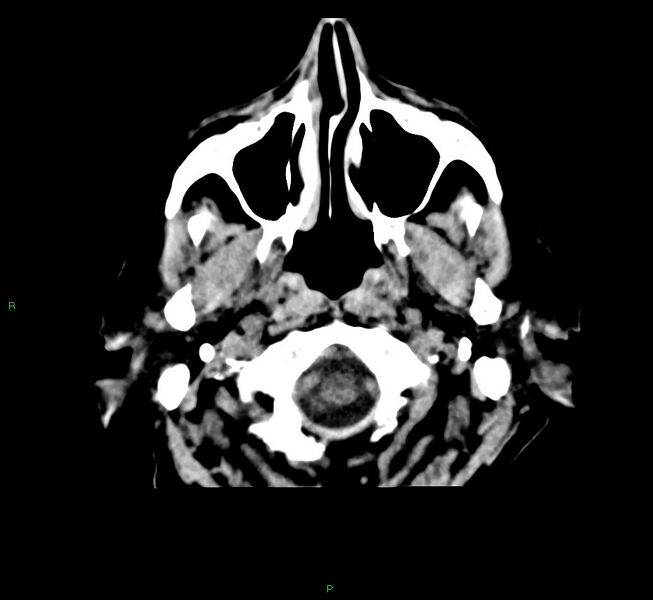 File:Cerebral amyloid angiopathy-associated lobar intracerebral hemorrhage (Radiopaedia 58376-65511 Axial non-contrast 52).jpg