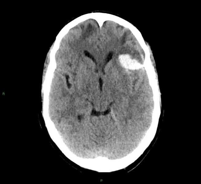 File:Cerebral amyloid angiopathy-associated lobar intracerebral hemorrhage (Radiopaedia 58529-65687 Axial non-contrast 31).jpg