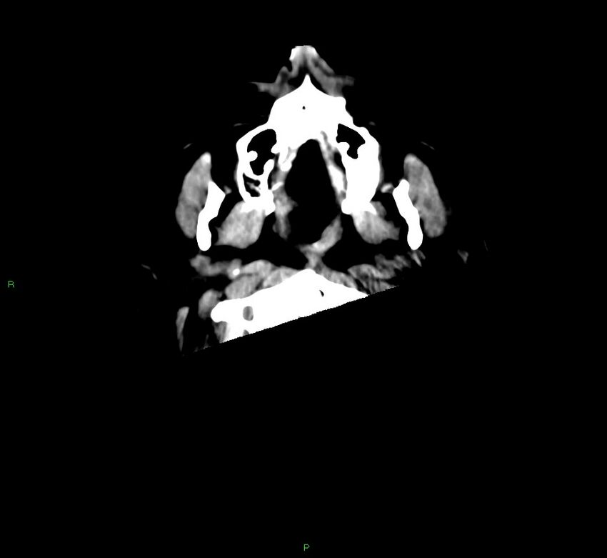 Cerebral amyloid angiopathy-associated lobar intracerebral hemorrhage (Radiopaedia 58560-65723 Axial non-contrast 54).jpg