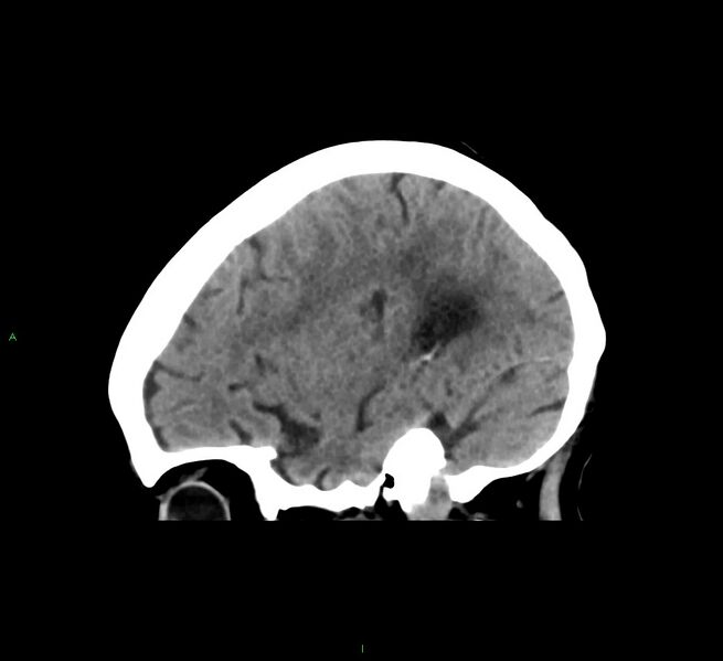 File:Cerebral amyloid angiopathy-associated lobar intracerebral hemorrhage (Radiopaedia 58563-65727 C 38).jpg