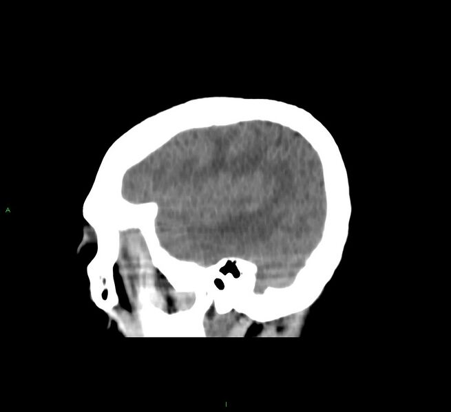 File:Cerebral amyloid angiopathy-associated lobar intracerebral hemorrhage (Radiopaedia 58751-65972 C 43).jpg