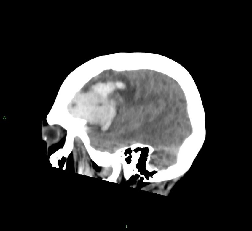 Cerebral amyloid angiopathy-associated lobar intracerebral hemorrhage (Radiopaedia 58752-65973 C 42).jpg
