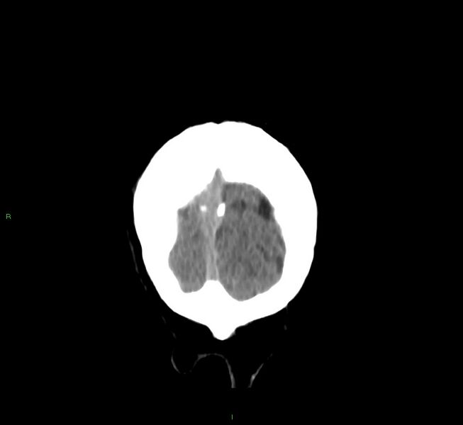 File:Cerebral amyloid angiopathy-associated lobar intracerebral hemorrhage (Radiopaedia 58756-65977 Coronal non-contrast 8).jpg