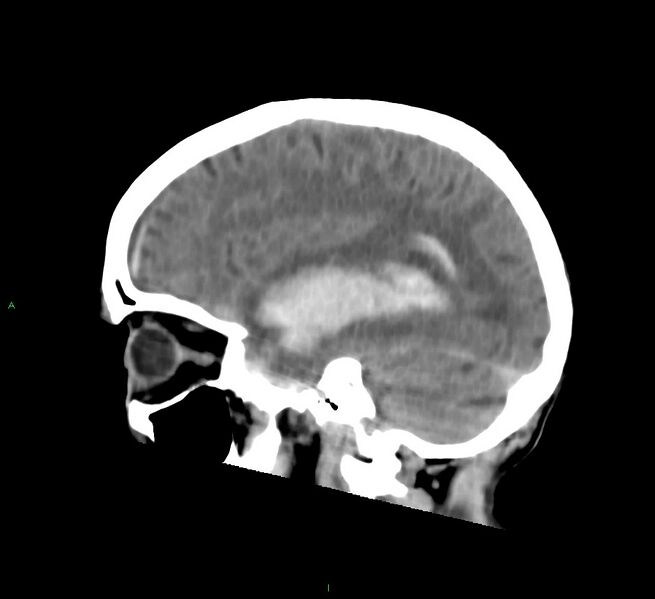 File:Cerebral amyloid angiopathy-associated lobar intracerebral hemorrhage (Radiopaedia 58758-65980 C 19).jpg