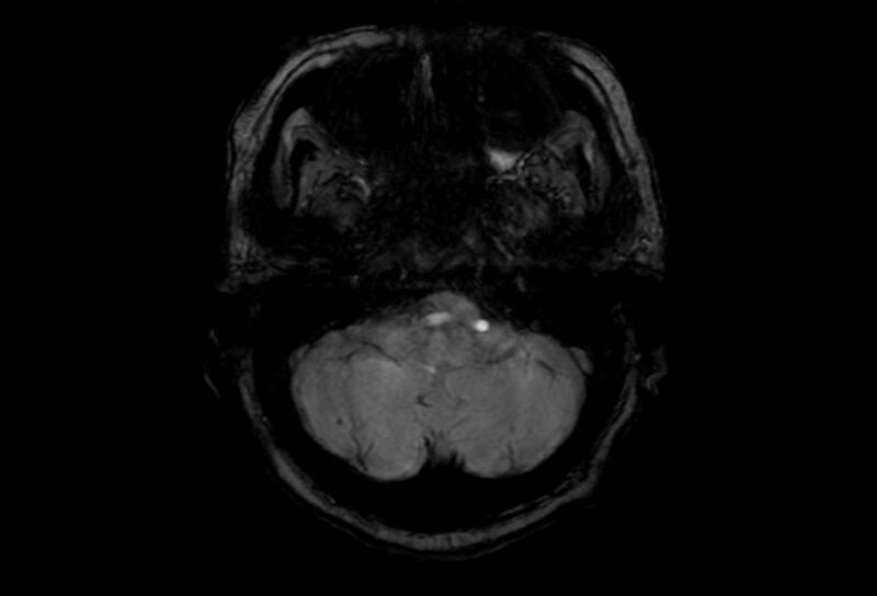File:Cerebral amyloid angiopathy (Radiopaedia 86671-102792 Axial Gradient Echo 48).jpg