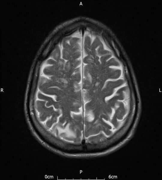File:Cerebral amyloid angiopathy related inflammation (Radiopaedia 72772-83415 Axial T2 18).jpg