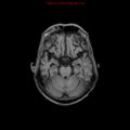 Cerebral and orbital tuberculomas (Radiopaedia 13308-13311 Axial T1 8).jpg