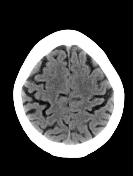 File:Cerebral aneurysm with rupture (Radiopaedia 29933-30457 Axial non-contrast 21).jpg