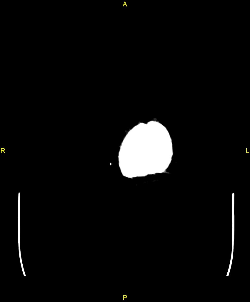 Cerebral autosomal dominant arteriopathy with subcortical infarcts and leukoencephalopathy (CADASIL) (Radiopaedia 86108-102051 Axial non-contrast 119).jpg