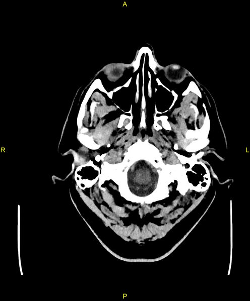 File:Cerebral autosomal dominant arteriopathy with subcortical infarcts and leukoencephalopathy (CADASIL) (Radiopaedia 86108-102051 Axial non-contrast 6).jpg