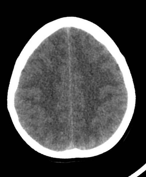 File:Cerebral edema due to severe hyponatremia (Radiopaedia 89826-106937 Axial non-contrast 69).jpg