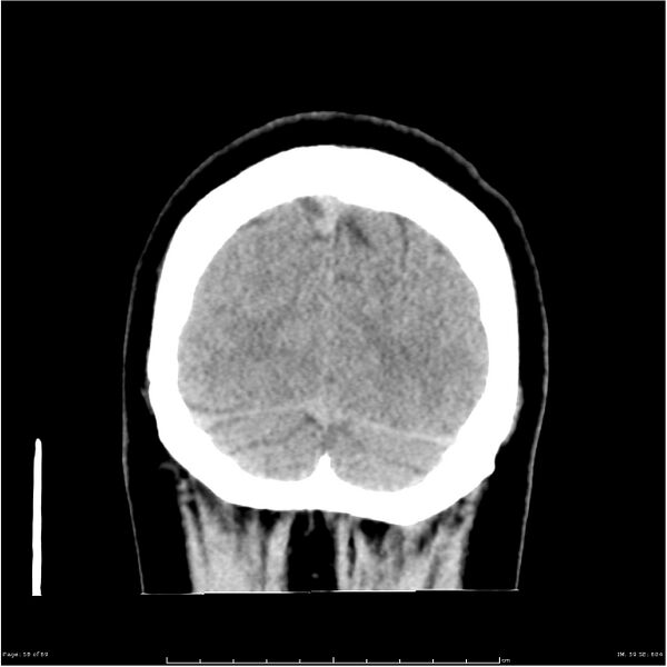 File:Cerebral hemorrhage secondary to arteriovenous malformation (Radiopaedia 33497-34561 Coronal non-contrast 49).jpg
