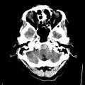 Cerebral hemorrhagic contusions (Radiopaedia 23145-23188 Axial non-contrast 5).jpg
