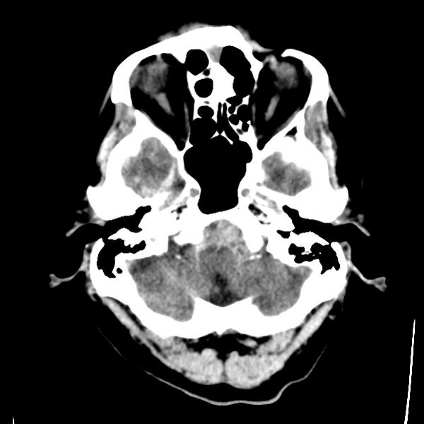 File:Cerebral hemorrhagic contusions (Radiopaedia 23145-23188 Axial non-contrast 5).jpg