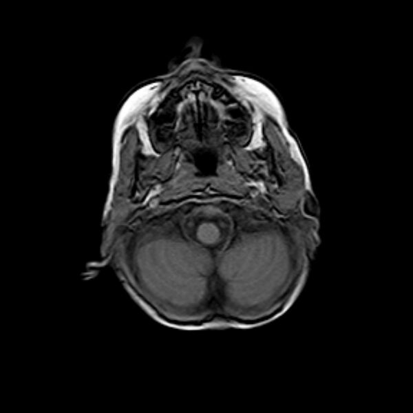 File:Cerebral tuberculoma (Radiopaedia 41152-43932 Axial T1 2).jpg