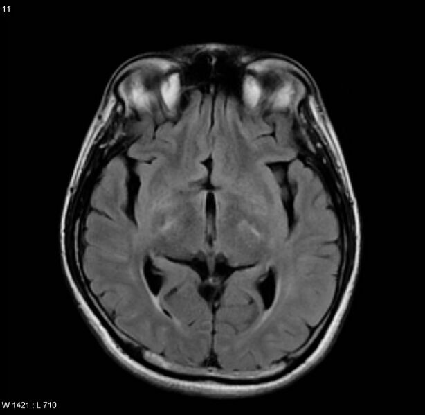 File:Cerebral vasculitis (Radiopaedia 5131-6923 Axial FLAIR 4).jpg