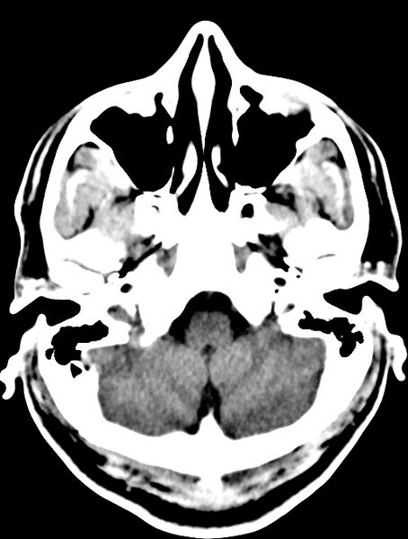 File:Cerebral venous angioma (Radiopaedia 69959-79977 Axial non-contrast 7).jpg