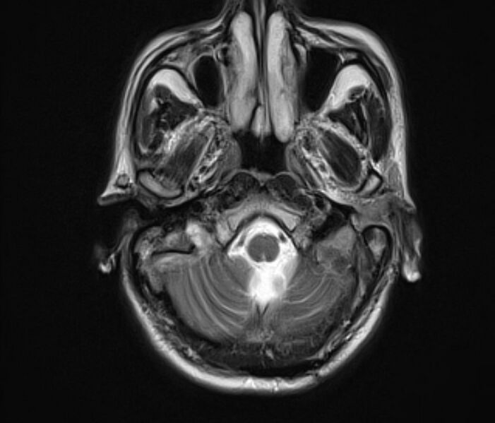 File:Cerebral venous thrombosis (Radiopaedia 71207-81504 Axial T2 5).jpg