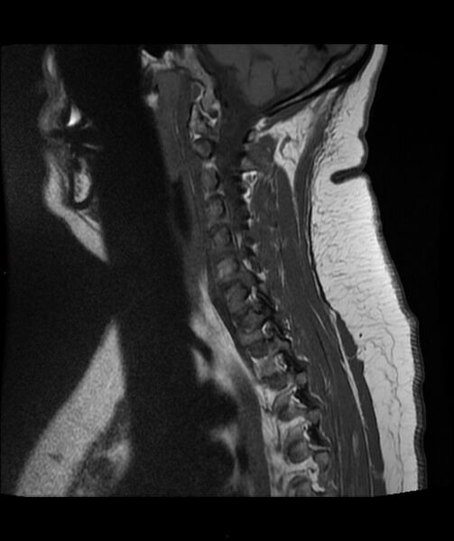 File:Cervical disc prolapse (Radiopaedia 80258-93598 Sagittal T1 11).jpg
