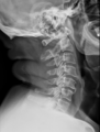 Cervical intercalary bones (Radiopaedia 61942).PNG