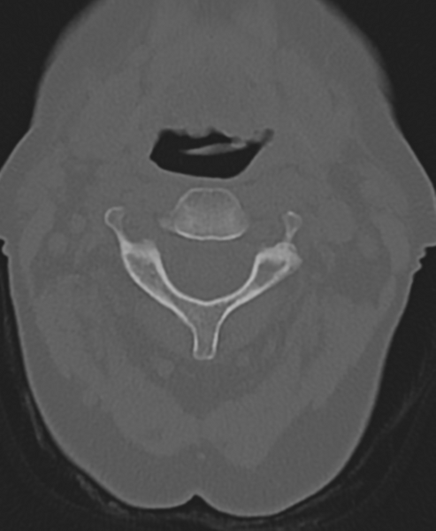 File:Cervical spine ACDF loosening (Radiopaedia 48998-54071 Axial bone window 21).png