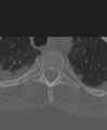 Cervical spine ACDF loosening (Radiopaedia 48998-54071 Axial bone window 61).png