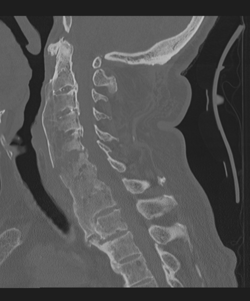 File:Cervical spine fracture in the setting of ankylosis (Radiopaedia 37038-38715 Sagittal bone window 41).png