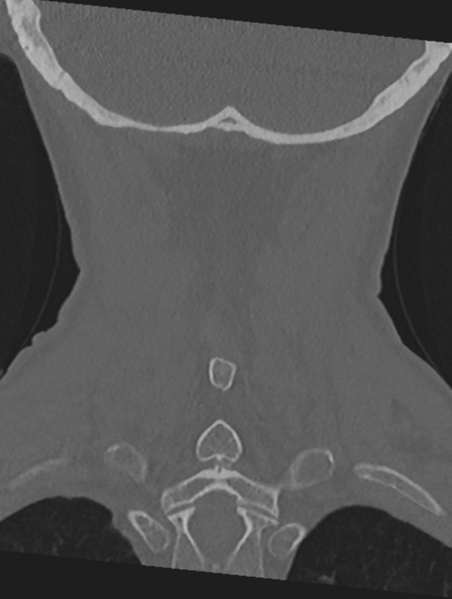 File:Cervical spondylolysis (Radiopaedia 49616-54811 Coronal bone window 48).png