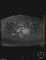 Cesarian scar endometriosis (Radiopaedia 68495-78066 Axial T1 C+ fat sat 18).jpg